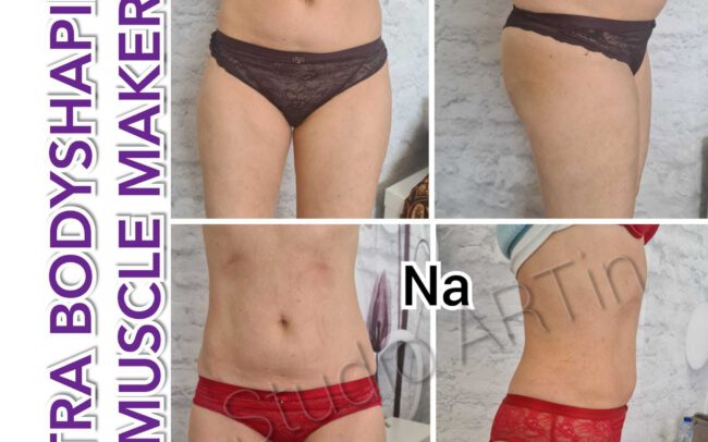 Bodysculpting Resultaat